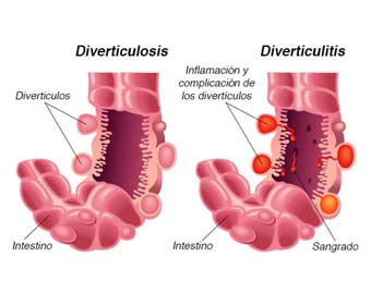 Im Genes De Diverticulosis Y Diverticulitis